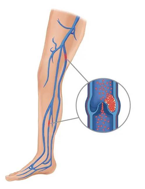 Blood clot prevention after surgery