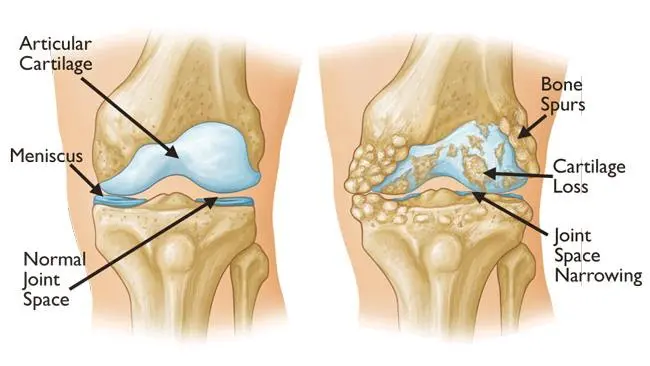 Causes of joint pain