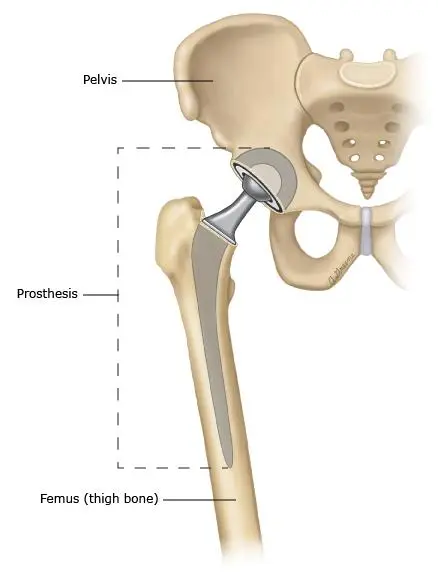 Hip replacement illustration