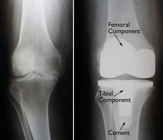 Knee implant X-ray