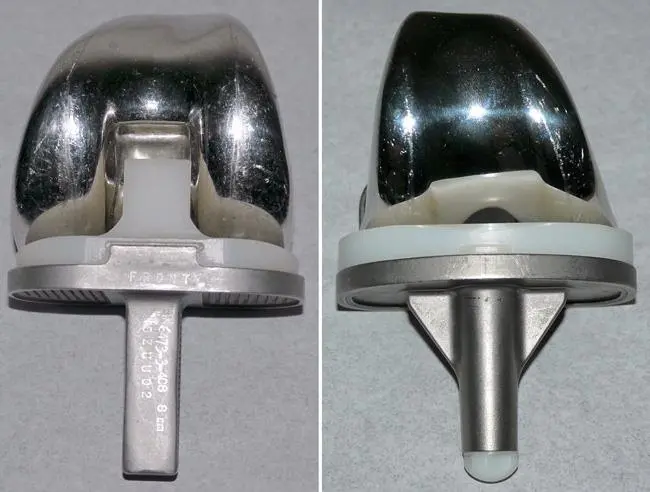 Knee replacement surgery