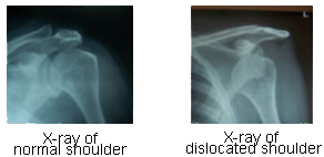 Shoulder 3