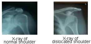 Shoulder 3