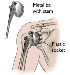 Shoulder replacement option