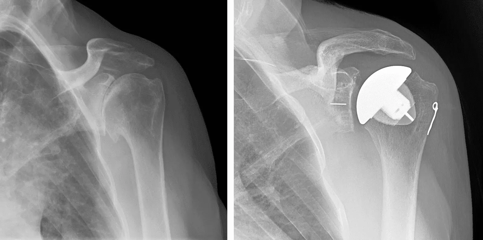 Shoulder prosthesis