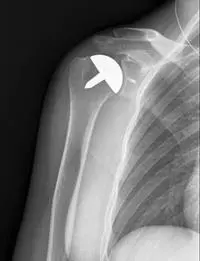 Shoulder surgery procedure