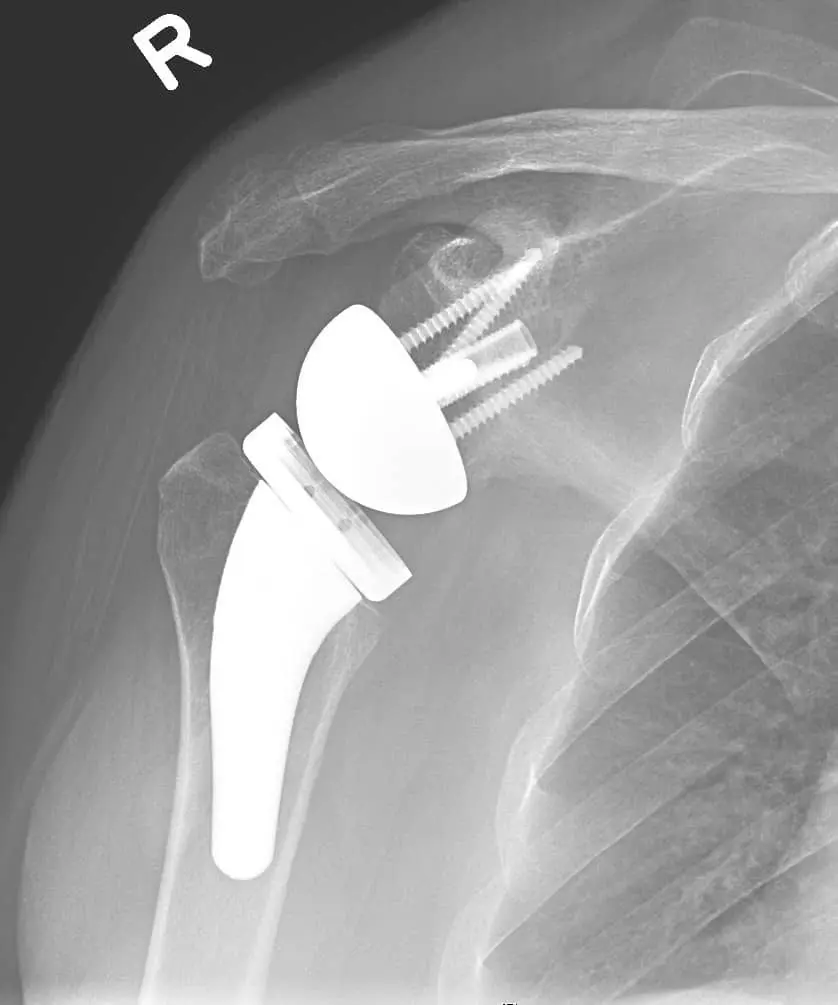 Shoulder arthroscopy
