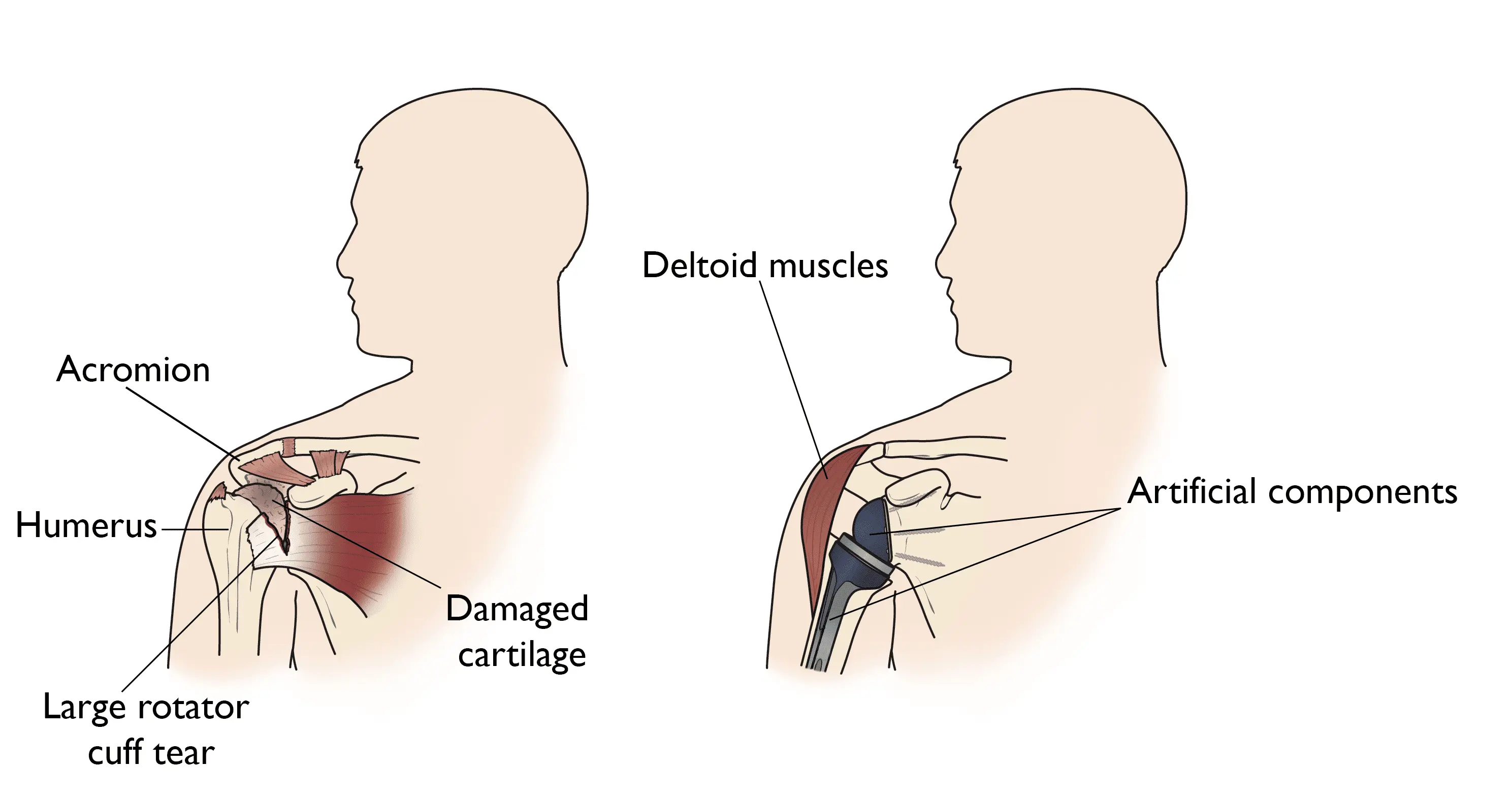 Shoulder joint replacement