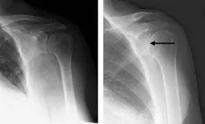 Shoulder treatment option