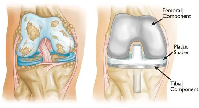 Joint spacer implant
