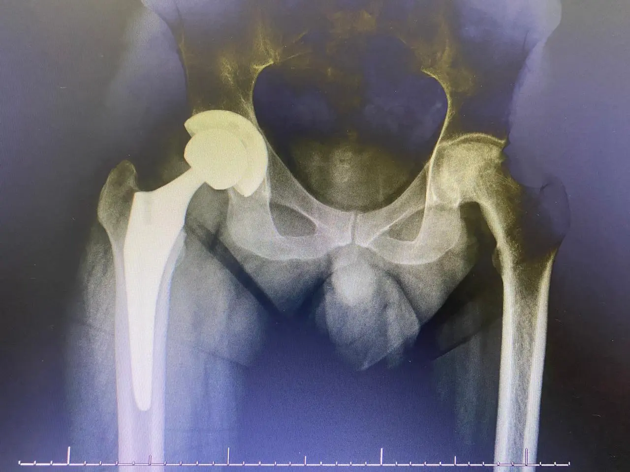 Patient testimonial hip replacement