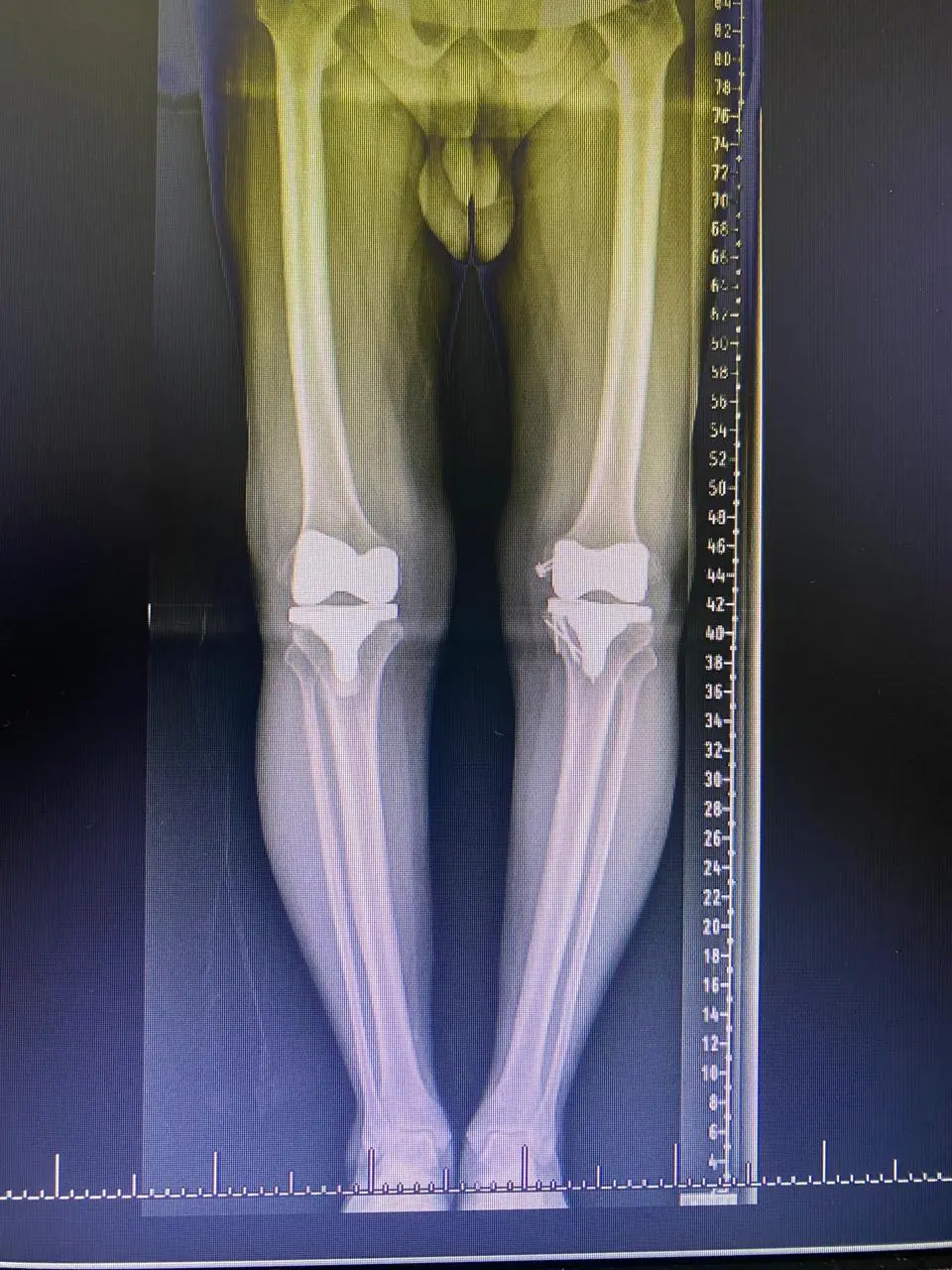 Patient testimonial knee replacement
